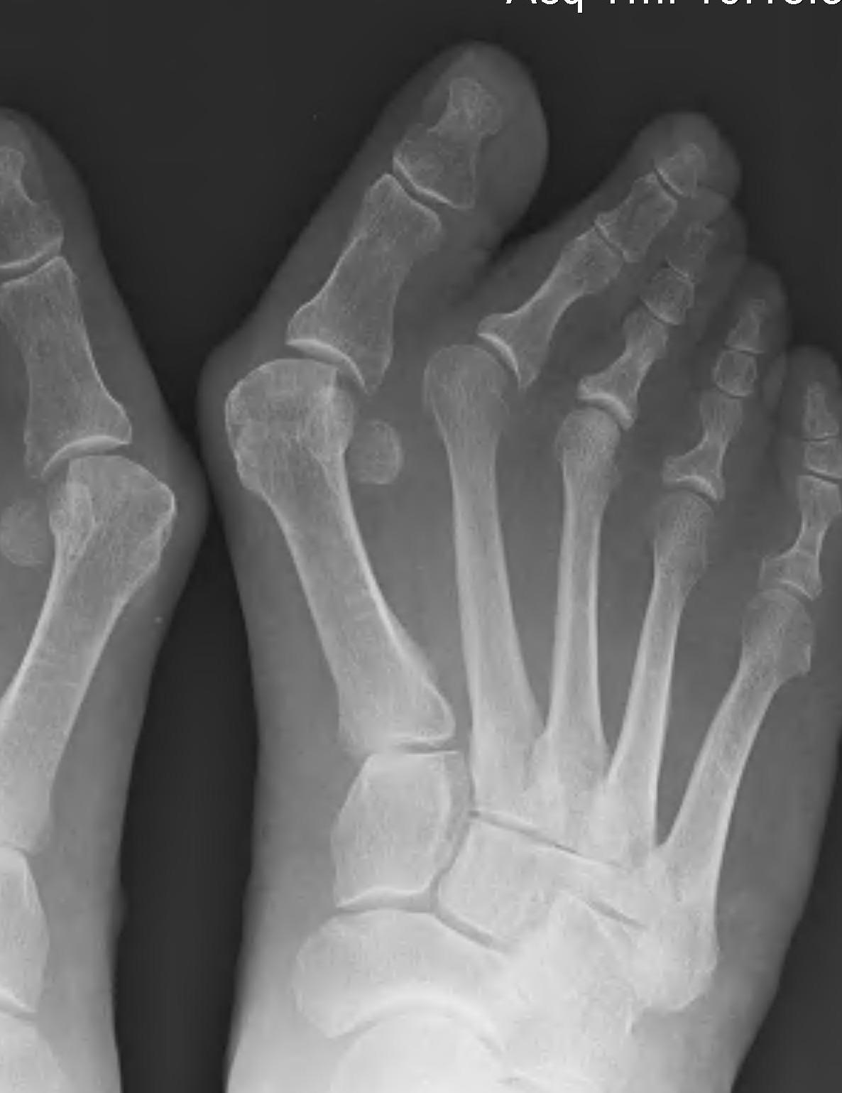 Hallux Valgus Severe